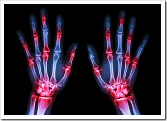 Rheumatoid Arthritis Solutions Miami FL