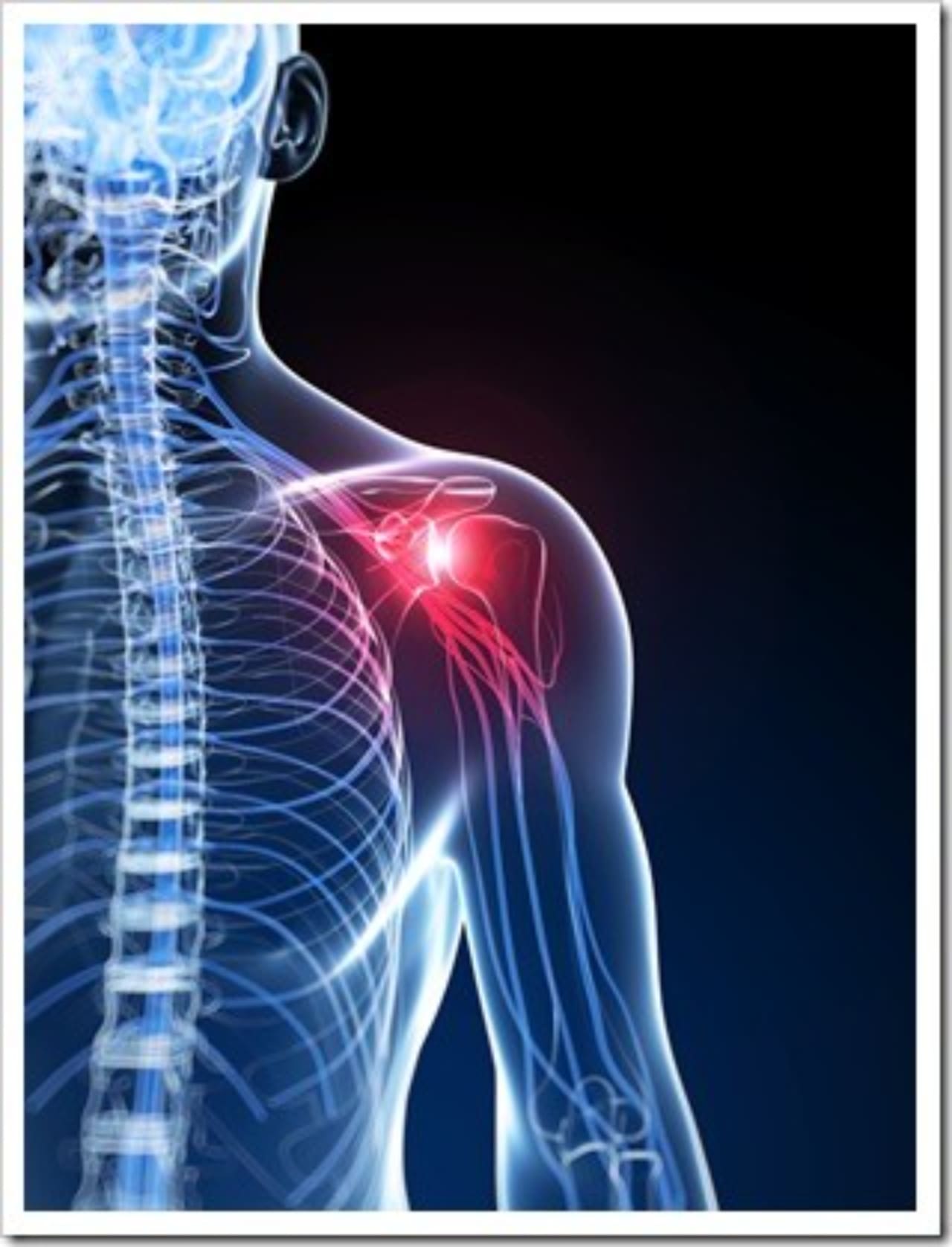 Frozen Shoulder Miami FL Neck Pain