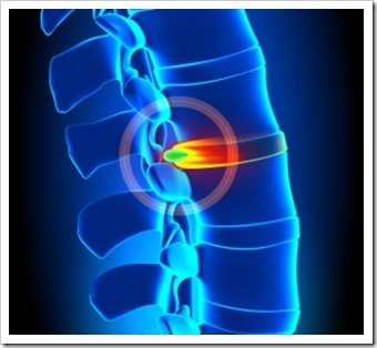 Back Pain Miami FL Spinal Decompression
