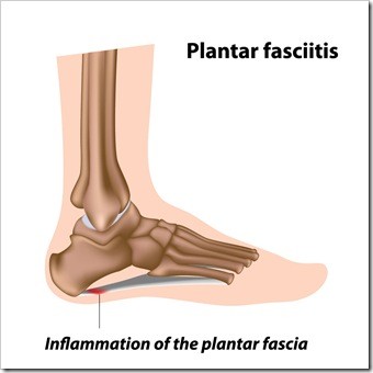 Foot Pain Miami FL Plantar Fasciitis