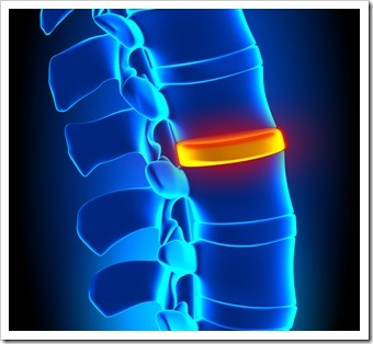 Herniated Disc and Back Pain Miami FL